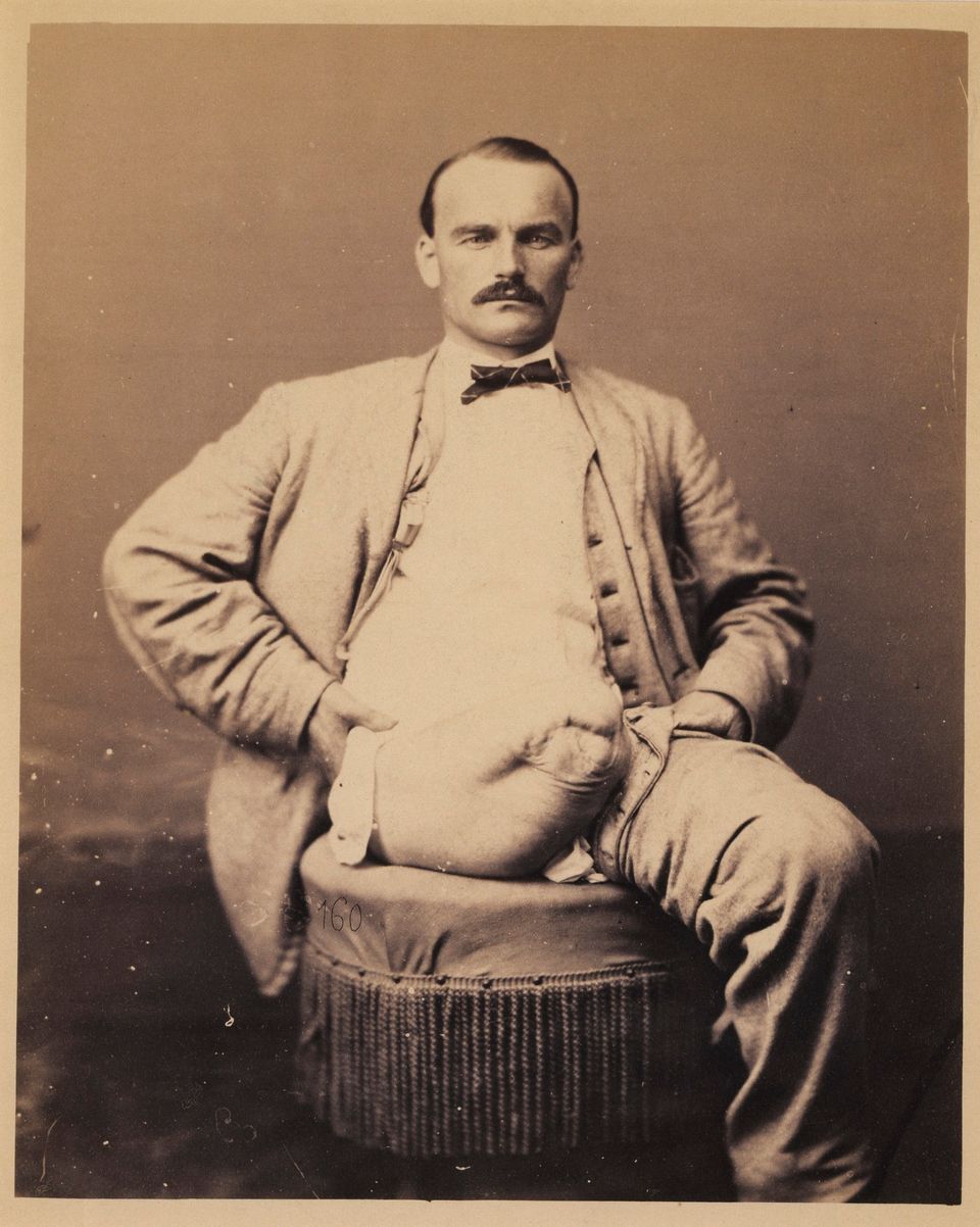 Private Charles Myer, Amputation of the Right Thigh, from the Photographic  Catalogue of the Surgical Section