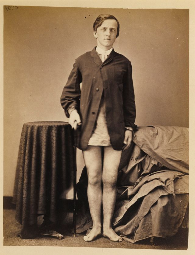 Private Charles Myer, Amputation of the Right Thigh, from the